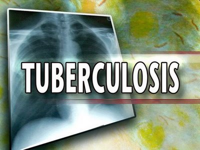 Tuberkolosis (TB)